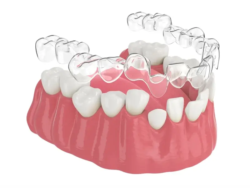 Invisalign plan leczenia