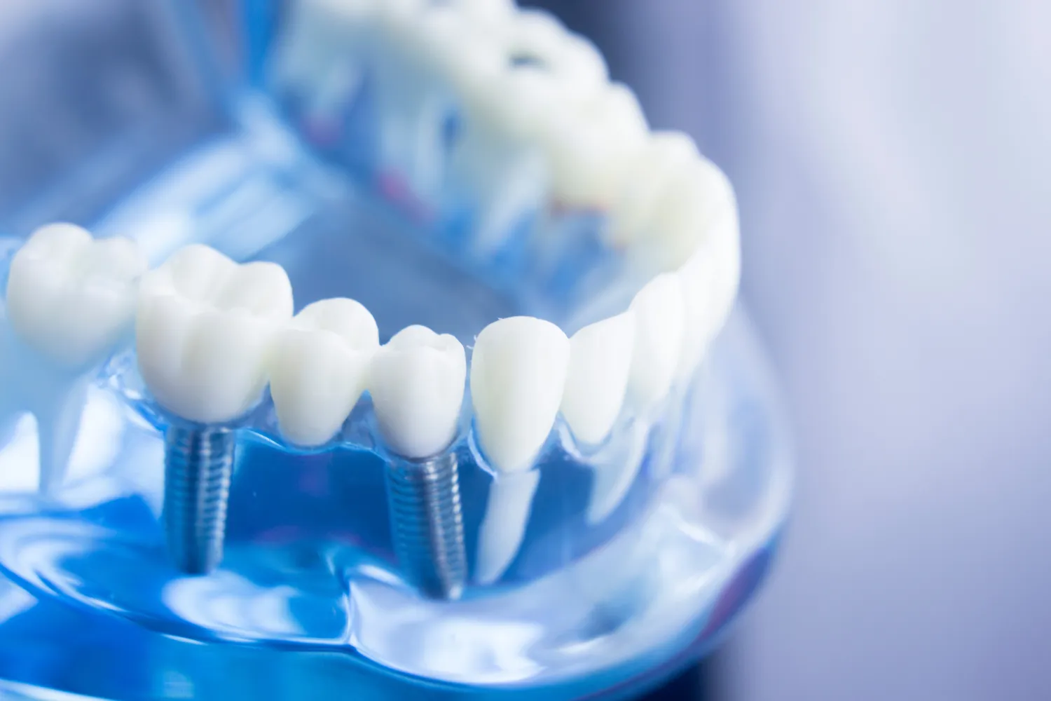Implanty Lublin gdzie najlepiej?