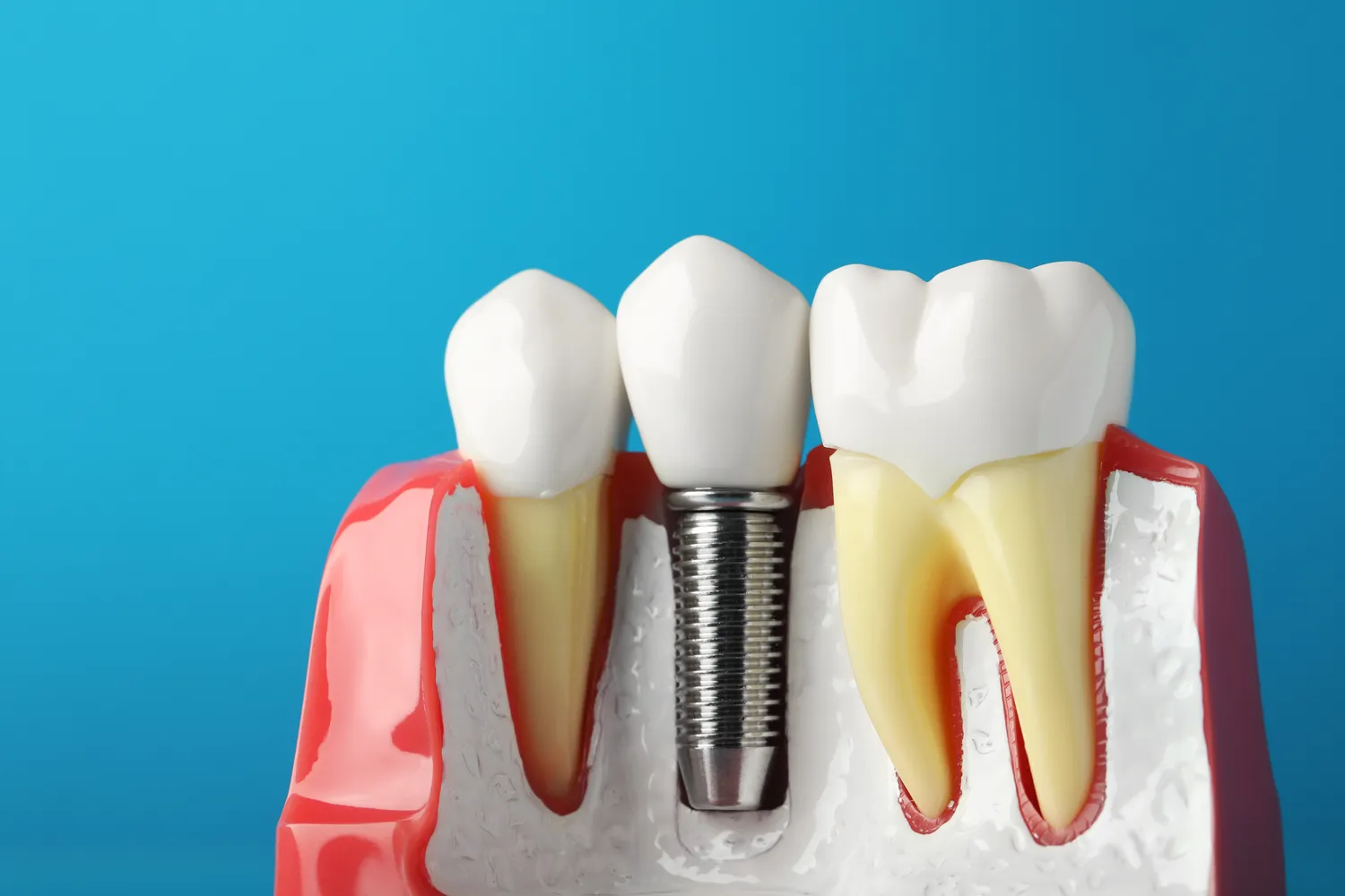 Stomatolog wykona odbudowę uzębienia przy pomocy implantów zębowych